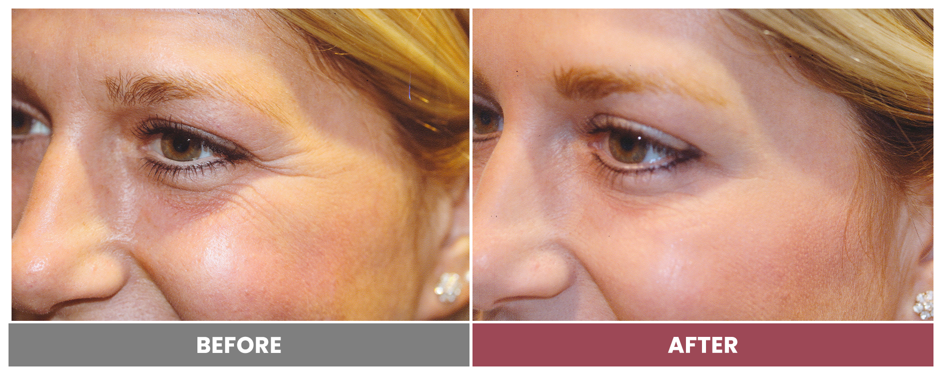 BOTOX FOR WRINKLES & BROW LIFT - Case 4